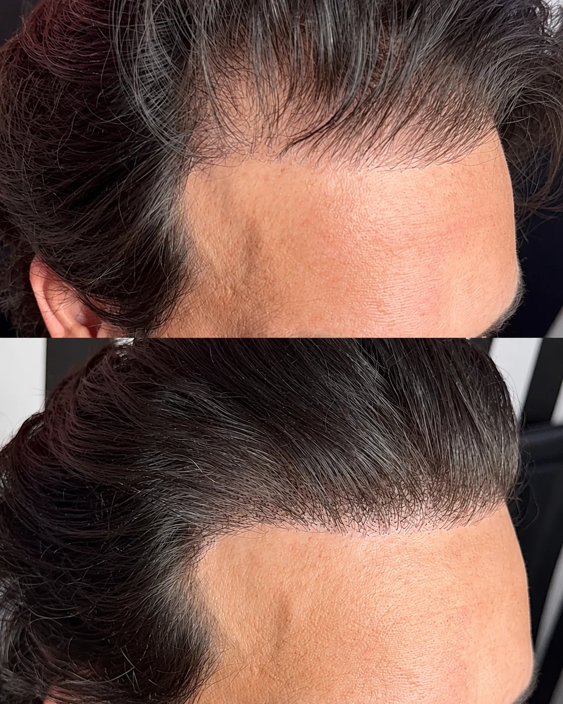 Scalp microblading before and after: top, a receding front hairline with sparse grey and dark hair; bottom, the same hairline filled in with fine hair strokes