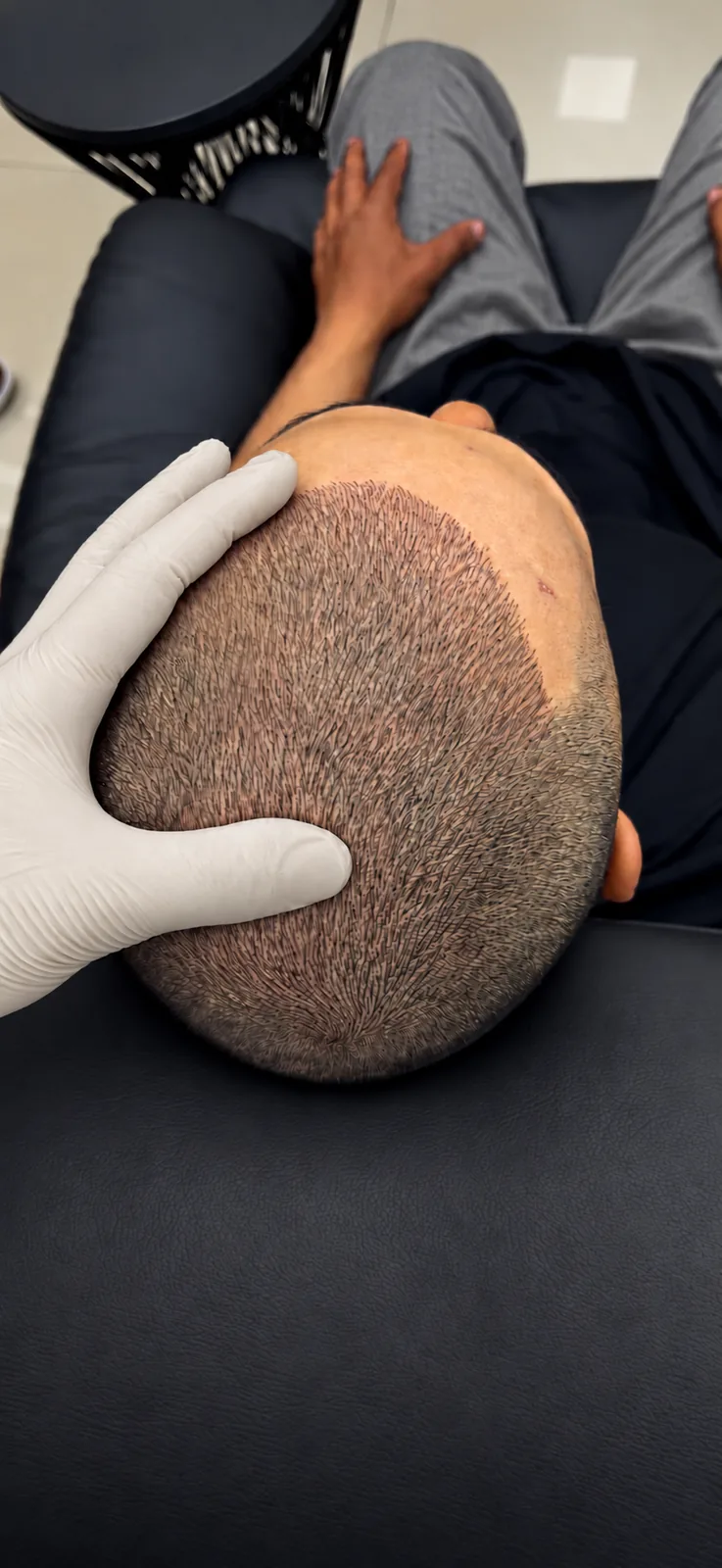 Close-cropped head seen from above, a gloved hand steadying it: hair strokes fill the thinner zone up to a soft edge