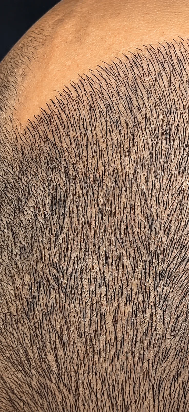 Close-up of individual hair strokes between short-cropped hairs on the scalp