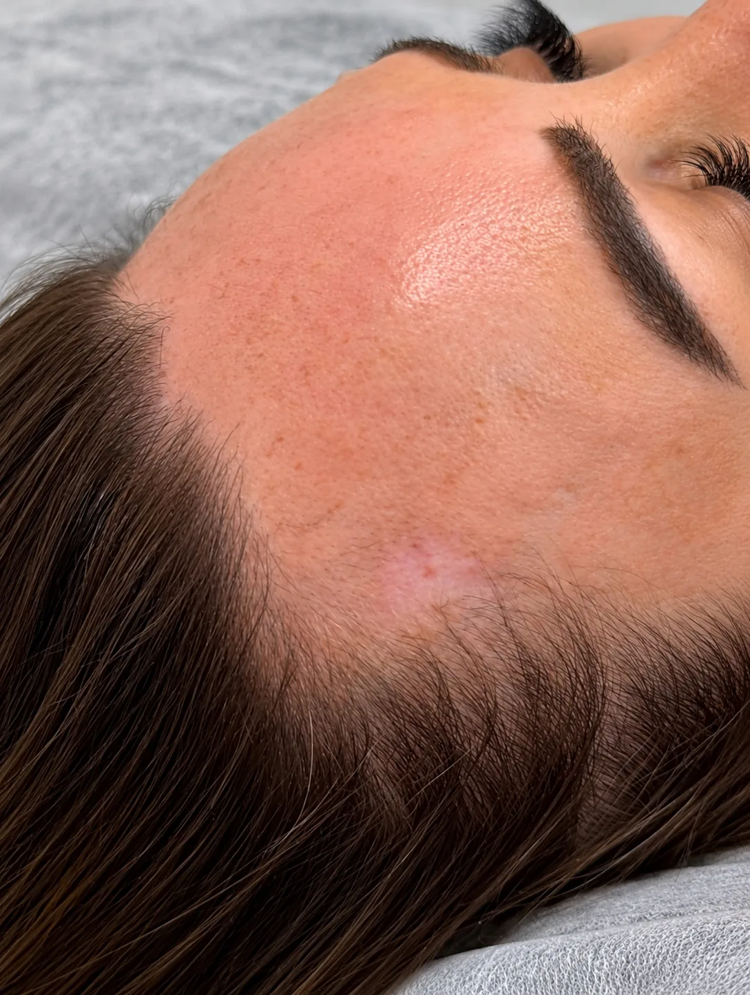 Scalp microblading along a woman's temple and side hairline, fresh hair strokes with the forehead skin still pink
